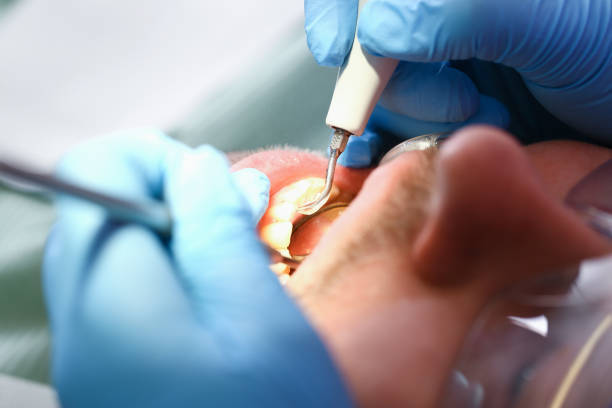 Best Emergency Treatment for Dental Infections or Abscesses in Portland, MI